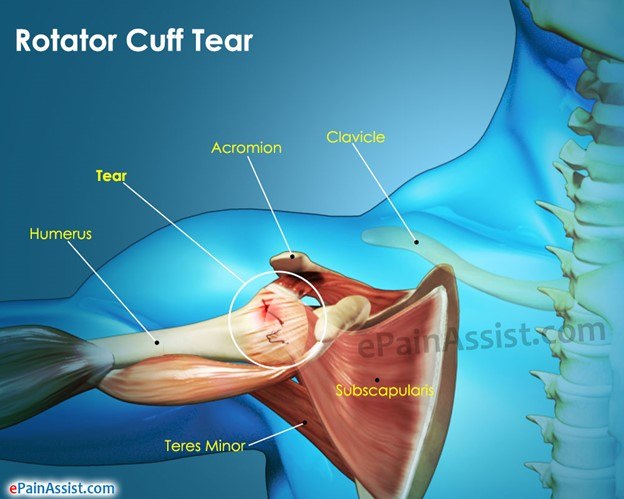 Dealing With A Rotator Cuff Injury-sunnybay